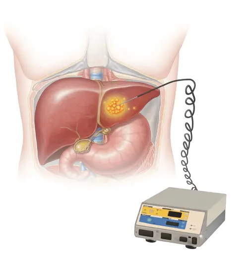 ablacion por radiofrecuencia