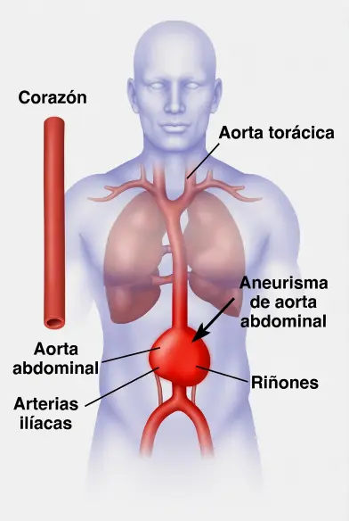 Tratamiento del aneurisma de aorta