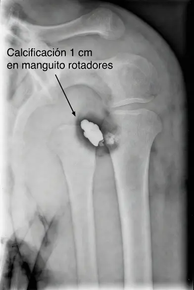 Tratamiento de las calcificaciones