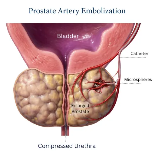 embolizacion de prostata