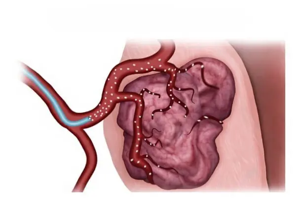 embolizacion miomas uterinos