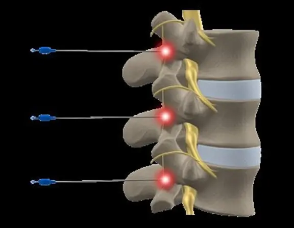 rizolisis lumbar