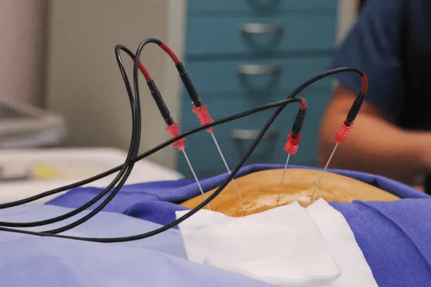 rizolisis